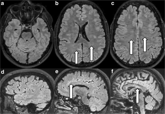 Common artefacts encountered on images acquired with combined compressed  sensing and SENSE | Insights into Imaging | Full Text