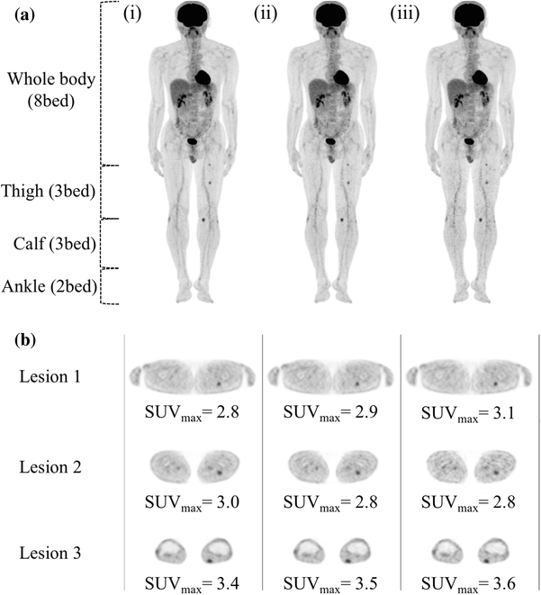 Optimization Of A Shorter Variable Acquisition Time For Legs To Achieve True Whole Body Pet Ct Images Springerlink Optimization Of A Shorter Variable Acquisition Time For Legs To Achieve True Whole Body Pet Ct Images Springerlink