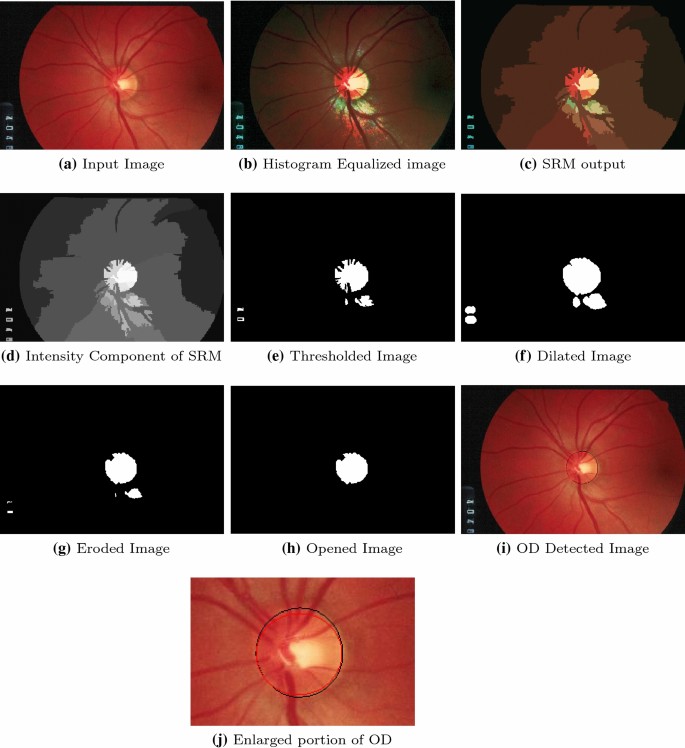 Automated Segmentation Of Optic Disc Using Statistical Region Merging And Morphological Operations Springerlink