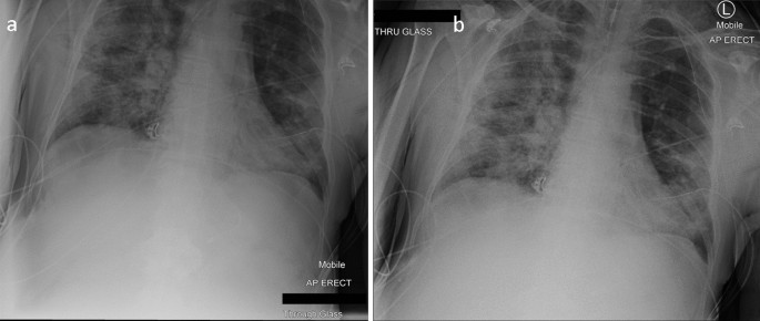 exposure to x ray