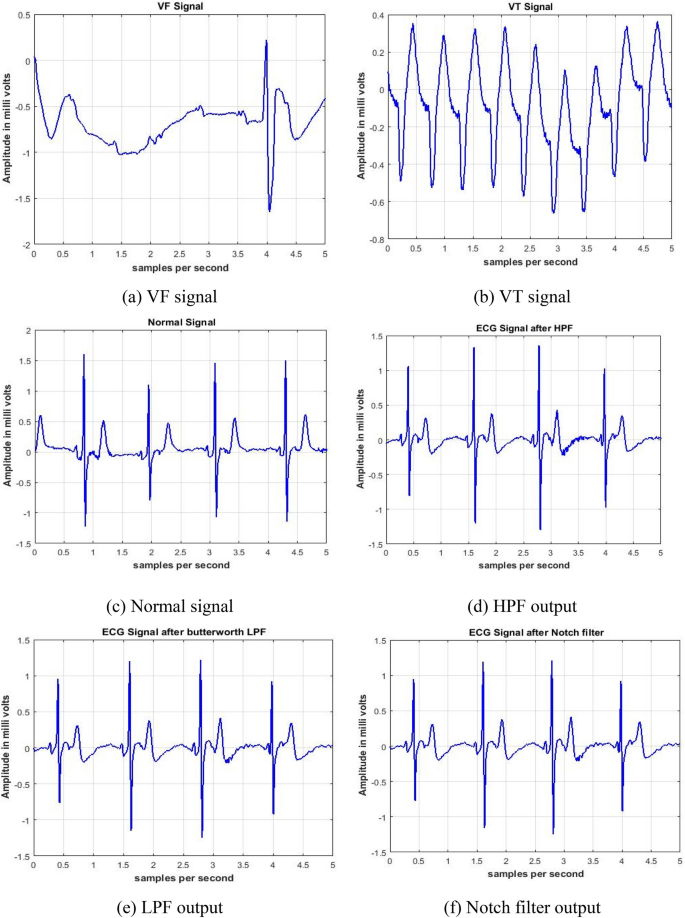 Detection Of Ventricular Arrhythmia Using Hybrid Time Frequency Based Features And Deep Neural Network Springerlink Detection Of Ventricular Arrhythmia Using Hybrid Time Frequency Based Features And Deep Neural Network Springerlink