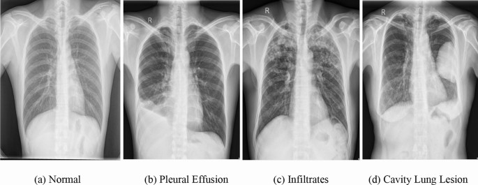 Ensemble Learning Based Automatic Detection Of Tuberculosis In Chest X Ray Images Using Hybrid Feature Descriptors Springerlink