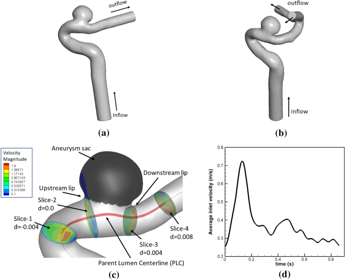 Effect of foam insertion in aneurysm sac on flow structures in parent  lumen: relating vortex structures with disturbed shear | SpringerLink