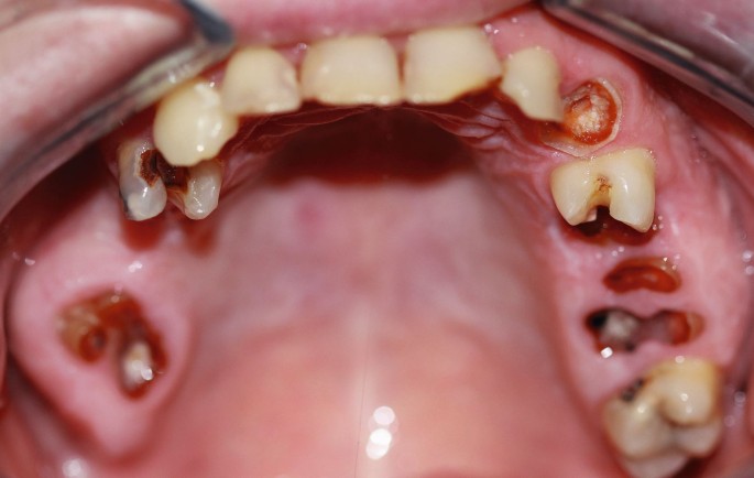 schadet vapen den zähnen Auswirkungen von Drogen auf die Mundgesundheit – ZWP online – das  Nachrichtenportal für die Dentalbranche