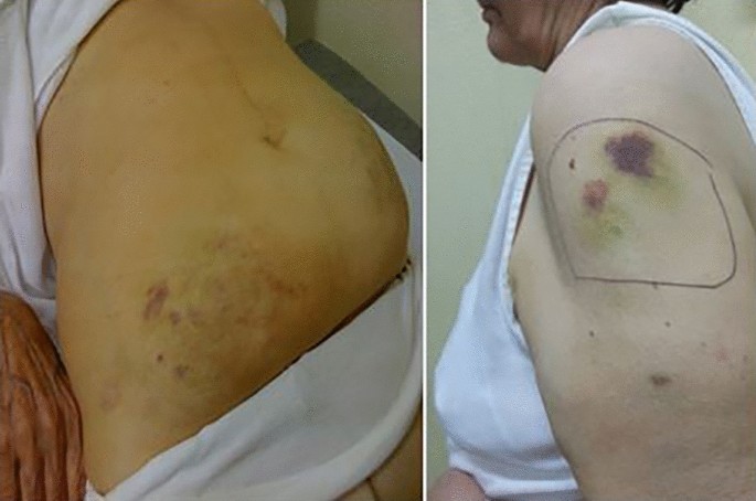 Bruising A Neglected Though Patient Relevant Complication Of Insulin Injections Coming To Light From A Real Life Nationwide Survey Springerlink