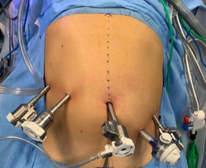 Robotic spleen-preserving distal pancreatectomy: the Verona experience |  SpringerLink