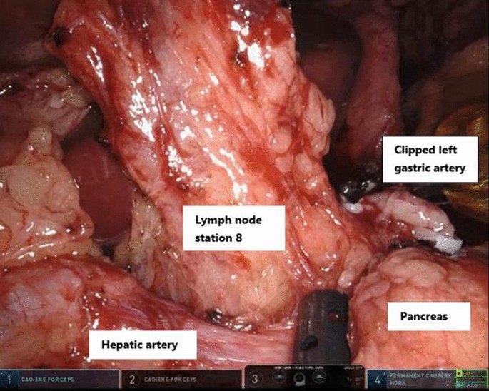 State Of The Art In Esophagectomy Robotic Assistance In The Abdominal Phase Springerlink