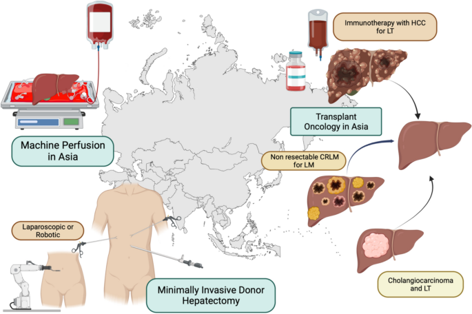 Trends of liver transplantation in Asia | Updates in Surgery