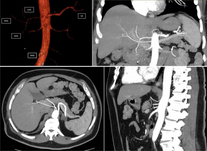 Surgical and oncological implications of the presence of hepatic artery ...