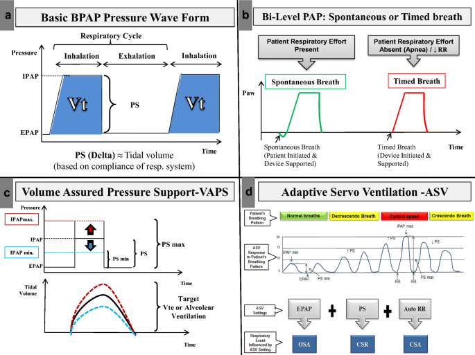 Sleep-Related Breathing Disorders: When CPAP Is Not Enough | SpringerLink