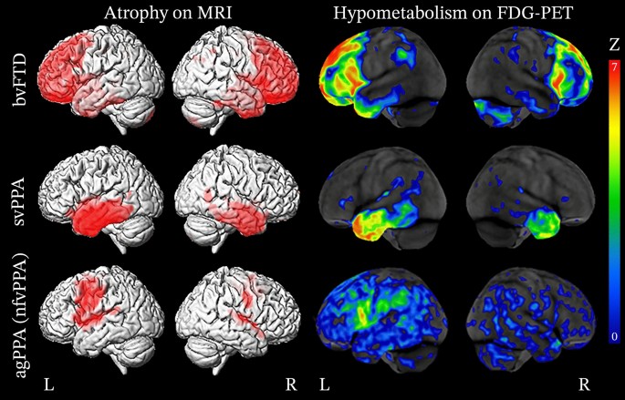 MRI an PET images of the brain by type of FTD to show patterns of atrophy and low brain metabolism associated with the three primary FTD clinical syndromes.