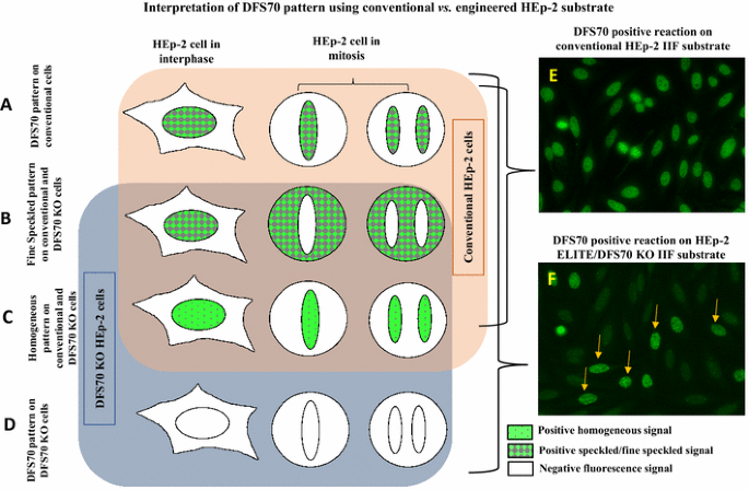 Analysis of DFS70 pattern and impact on ANA screening using a novel HEp-2  ELITE/DFS70 knockout substrate | Autoimmunity Highlights | Full Text