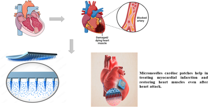 Microneedle patches: the next frontier in cardiovascular care | Drug  Delivery and Translational Research | Springer Nature Link