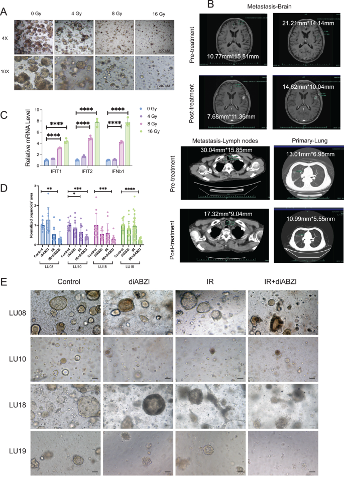 Optimized patient-derived lung cancer organoids recapitulating the ...