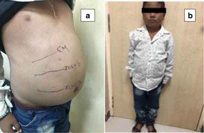 Mauriac Syndrome A Rare Cause Of Massive Hepatomegaly Springerlink