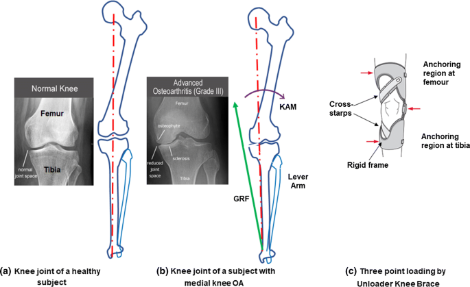 Methods for evaluating effects of unloader knee braces on joint health: a  review | SpringerLink