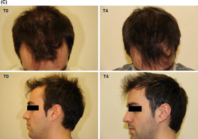 Clinical Efficacy of Treatment by Crescina® Human Follicle Stem Cell on Healthy Males Androgenetic Alopecia | and Therapy