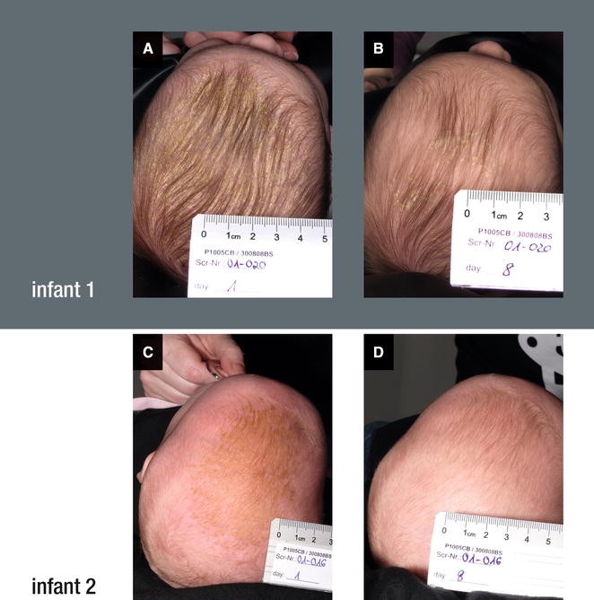 Topical, Non-Medicated LOYON® in Facilitating the Removal of Scaling in  Infants and Children with Cradle Cap: a Proof-of-Concept Pilot Study |  SpringerLink
