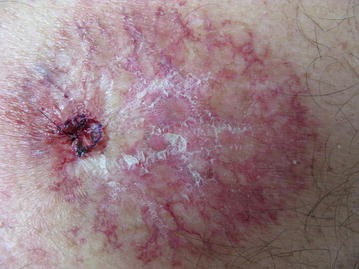 Acute and Chronic Cutaneous Reactions to Ionizing Radiation Therapy |  Dermatology and Therapy