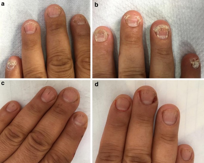 corticosteroids for nail psoriasis