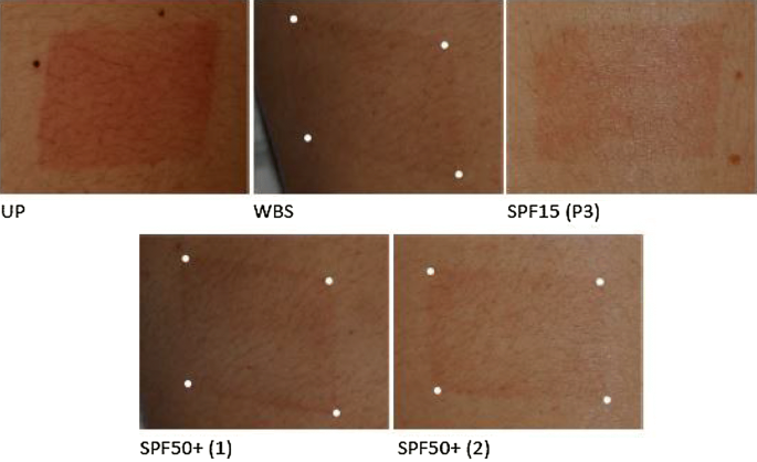 New Methodology To Evaluate Sunscreens Under Outdoor Conditions A Double Blind Randomized Intra Individual Clinical Study Of A Water Based Broad Spectrum Spf50 Versus Spf15 P3 And Spf50 Springerlink