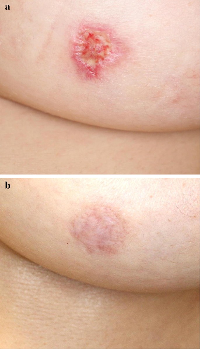 images Mycosis Fungoides Pictures Early Stages folliculotropic mycosis fungoides