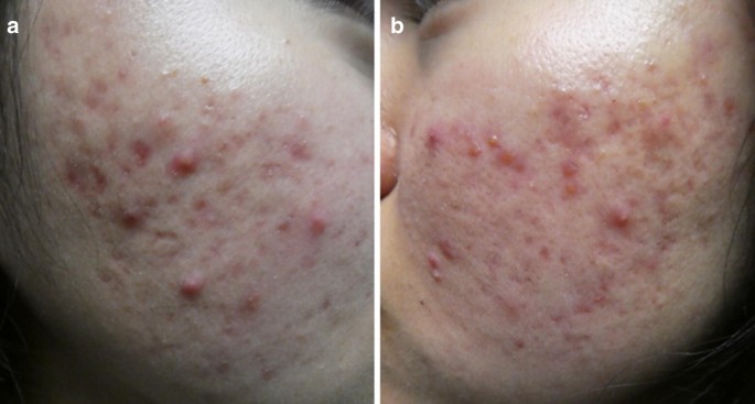 Acne Vulgaris: A Patient and Physician's Experience | SpringerLink Acne Vulgaris: A Patient and Physician's Experience | SpringerLink