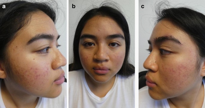 Acne Vulgaris: A Patient and Physician's Experience | SpringerLink Acne Vulgaris: A Patient and Physician's Experience | SpringerLink