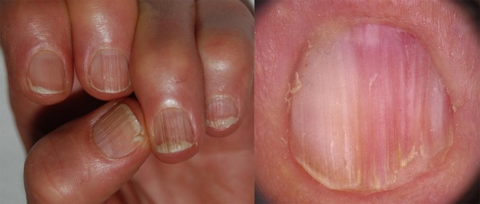 Fingernail Ridges: Causes And Treatments For Vertical And Horizontal Nail  Lines