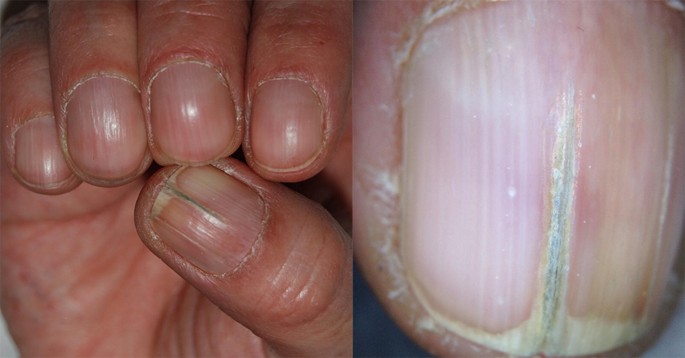 Pathogenesis, Clinical Signs and Treatment Recommendations in Brittle  Nails: A Review | SpringerLink
