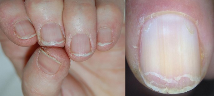 How to Stop Your Nails from Peeling: 12 Steps (with Pictures)