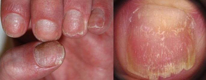 Pathogenesis, Clinical Signs and Treatment Recommendations in Brittle Nails:  A Review | SpringerLink