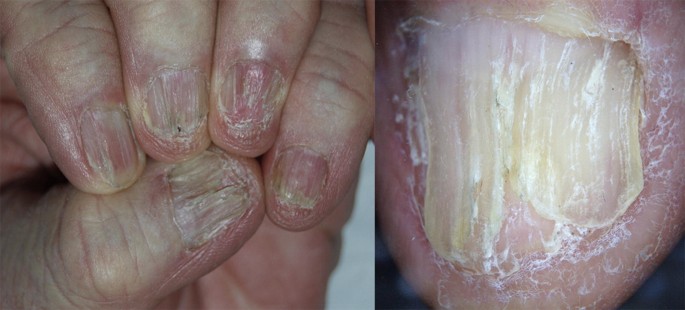 Pathogenesis, Clinical Signs and Treatment Recommendations in Brittle Nails:  A Review | SpringerLink