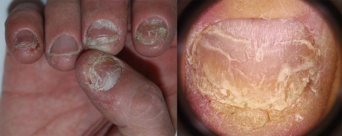 Brittle Toenails & Fingernails Signs, Causes,Treatment-Thyroid, Vitamin  Deficiency, Ridges Toddlers &Home Remedies