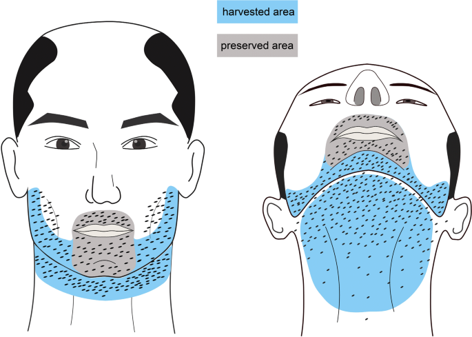 Large-Scale Beard Extraction Enhances the Cosmetic Results of Scalp Hair Restoration in Advanced Androgenetic Alopecia in East Asian Men: A Retrospective Study | SpringerLink Large-Scale Beard Extraction Enhances the Cosmetic Results of Scalp Hair Restoration in Advanced Androgenetic Alopecia in East Asian Men: A Retrospective Study | SpringerLink