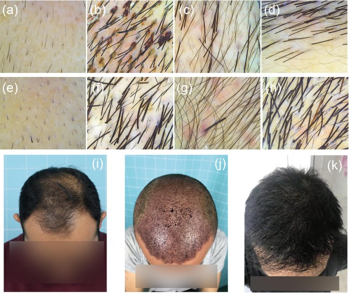 Large-Scale Beard Extraction Enhances the Cosmetic Results of Scalp Hair  Restoration in Advanced Androgenetic Alopecia in East Asian Men: A  Retrospective Study | SpringerLink