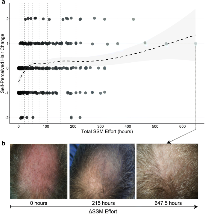 Self-Assessments of Standardized Scalp Massages for Androgenic Alopecia:  Survey Results | SpringerLink
