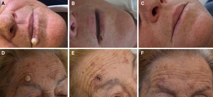 Intralesional Methotrexate For The Treatment Of Keratoacanthoma The Neapolitan Experience Springerlink