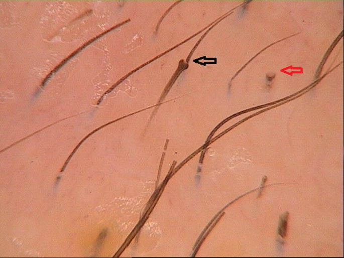 Genetic Hair Disorders: A Review | SpringerLink Genetic Hair Disorders: A Review | SpringerLink