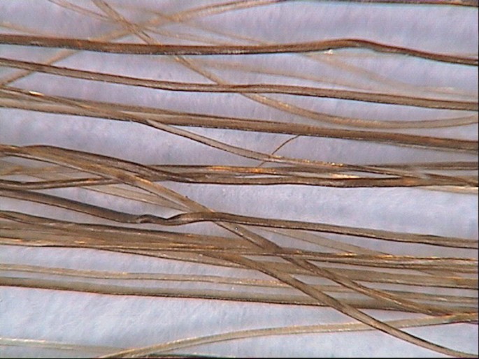 write a research paper about a hereditary condition or deformity figure 6