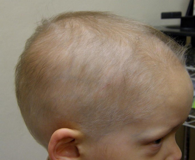 Genetic Hair Disorders: A Review | SpringerLink Genetic Hair Disorders: A Review | SpringerLink