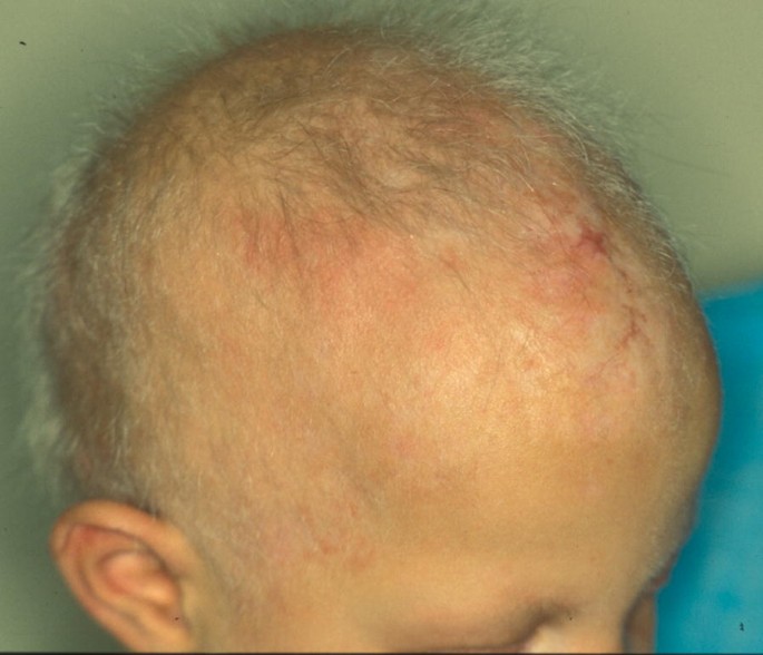 Genetic Hair Disorders: A Review | SpringerLink