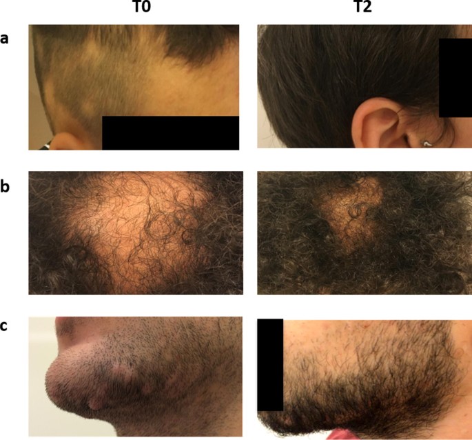 Efficacy of Postbiotics in a PRP-Like Cosmetic Product for the Treatment of  Alopecia Area Celsi: A Randomized Double-Blinded Parallel-Group Study |  SpringerLink
