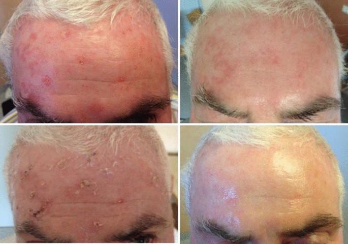 Treatment Of Actinic Keratoses