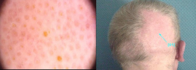 pics Mycosis Fungoides Tumor Stage Pictures folliculotropic mycosis fungoides