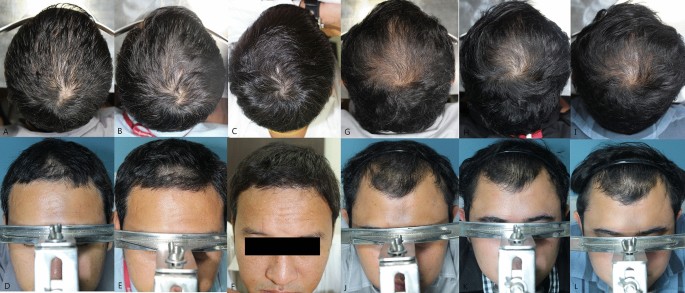 Efficacy and Safety of Oral Minoxidil 5 mg Once Daily in the Treatment of  Male Patients with Androgenetic Alopecia: An Open-Label and Global  Photographic Assessment | Dermatology and Therapy