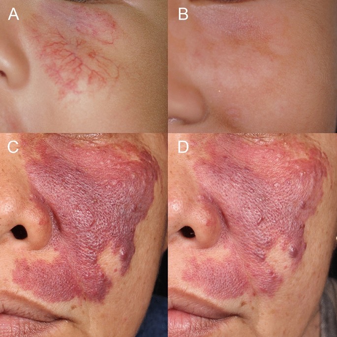 The Cost-Effectiveness of Pulsed-Dye Laser Therapy Among Thai Patients with  Facial Port-Wine Stain: A Retrospective Study and Economic Evaluation |  Dermatology and Therapy