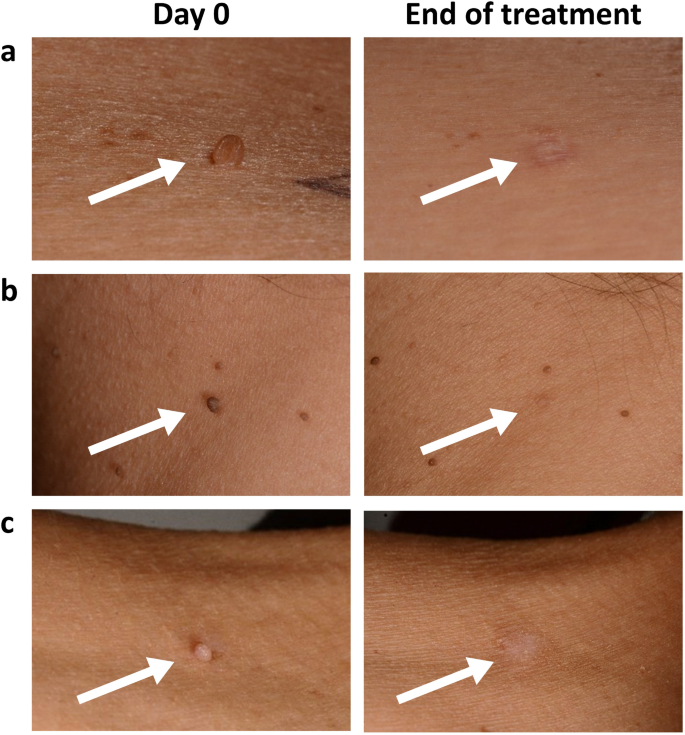 Efficacy Evaluation of the Pixie® Skin Tag Cryogenic Device on Skin Tags in  a Prospective, Single-Blinded, Randomized, Comparative Clinical Trial |  Dermatology and Therapy