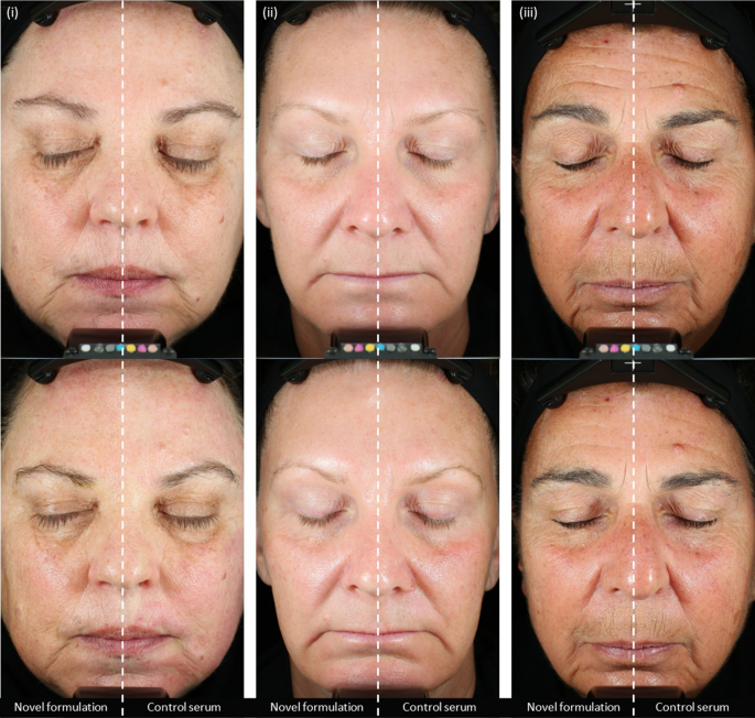 glutathione microneedling before and after Microneedling with a Novel, n-3-PUFA-Rich Formulation Accelerates  Inflammation Resolution to Improve Skin Recovery Outcomes in Adults with  Healthy Skin | Dermatology and Therapy