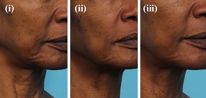 semaglutide avon Treating Skin Changes After GLP-1 Weight Loss semaglutide avon Treating Skin Changes After GLP-1 Weight Loss